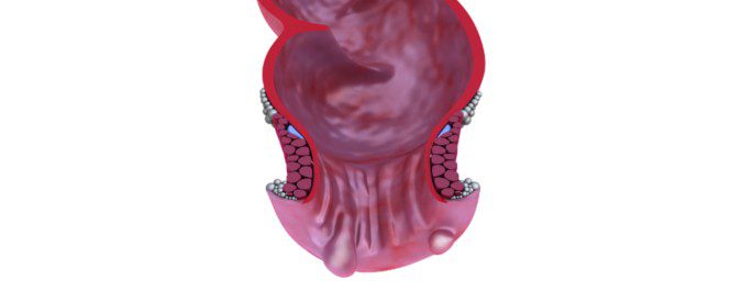 Las hemorroides son inflamaciones de las venas que se encuentran entre el recto y el ano
