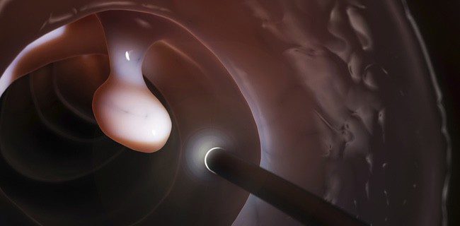 La colonoscopia es una forma sencilla de detectar y acabar con el cáncer de colon