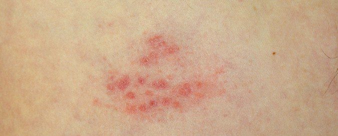 La alergia al frío produce urticaria