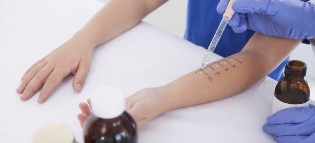 Una sencilla prueba de alergias puede determinar si tienes alergia a los gatos