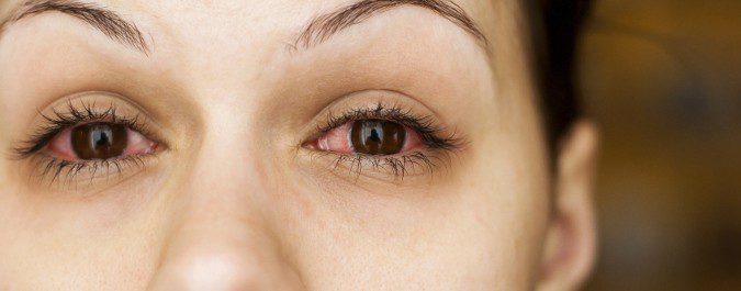 EL enrojecimiento ocular es el síntoma más común de la conjuntivitis alérgica
