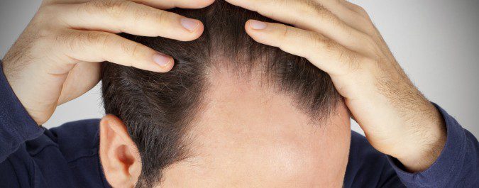 El Minoxidil ayuda a evitar la caída del pelo, pero no regenera el ya perdido