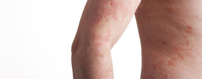 Picazón, enrojecimiento, descamacióny dolor son síntomas de psoriasis
