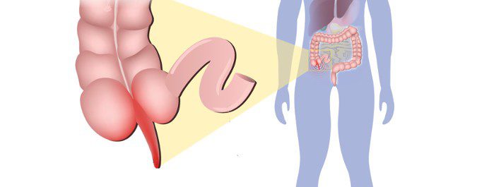 La apendicitis aparece cuando se obstruye el conducto del apéndice y éste se inflama