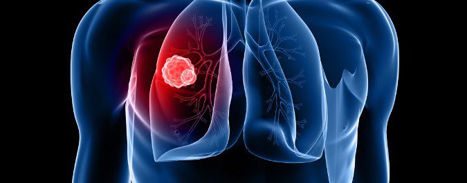 Cada vez hay menor riesgo de morir de cáncer de pulmón si se detecta a tiempo