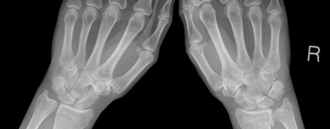 La osteoporosis debilita nuestros huesos y puede provocar dolor y lesiones en diferentes zonas