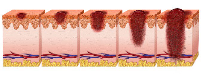 El melanoma puede comenzar en la piel normal o a partir de un lunar de nacimiento