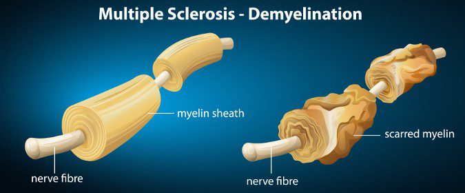 Los síntomas de la esclerosis múltiple se producen por la pérdida de la mielina de los axones de las células nerviosas