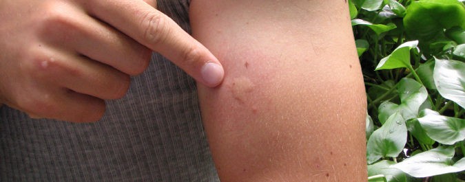 La picadura de mosquito pica a causa de la extensión del veneno al arrascarnos