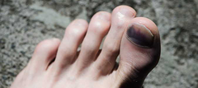 Al llevar chanclas debemos tener especial cuidado con los golpes, nuestros pies están más expuestos.