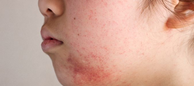  Suele aparecer durante la juventud y acompañarnos toda la vida