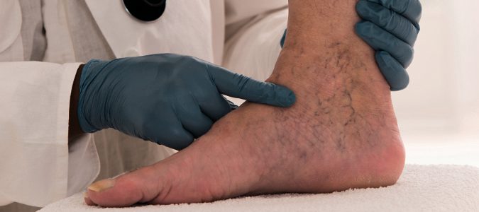 Las varices no solo aparecen en las piernas