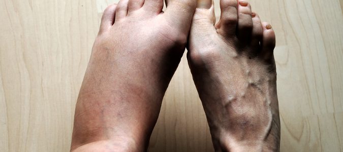 Uno de los primeros síntomas son los pies o manos hinchadas.