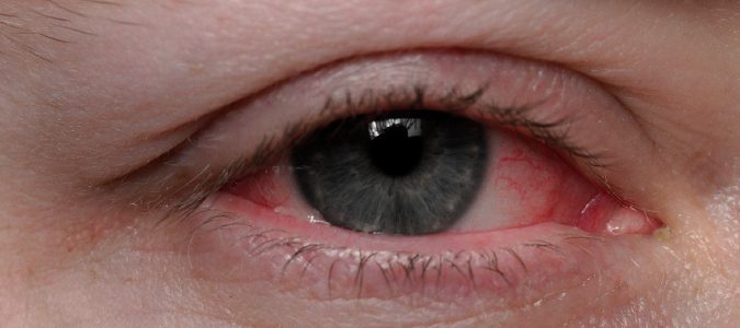 Ojo enrojecido