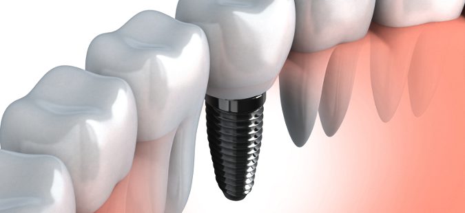 Implante dental