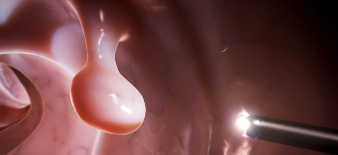 Colonoscopia