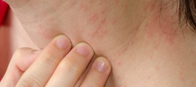 Dermatitis