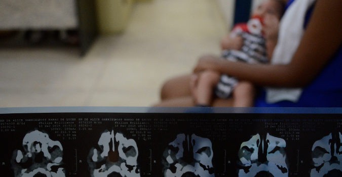 Los problemas derivados de la microcefalia dependen de la zona del cerebro afectada