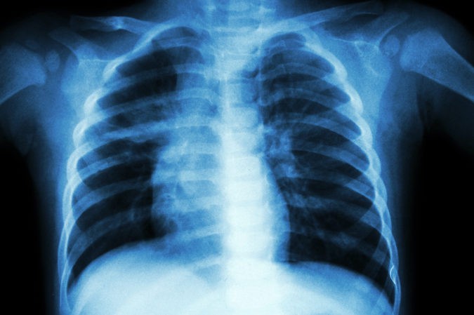El virus de la tuberculosis se instala principalmente en los pulmones