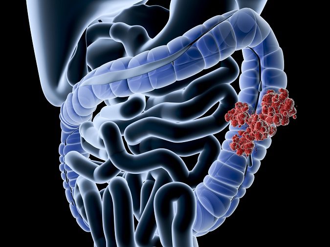 El cáncer de colon puede ocurrir a cualquier edad