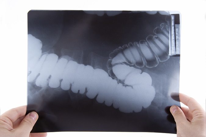 Es necesario tener unos buenos hábitos para prevenir el cáncer de colon