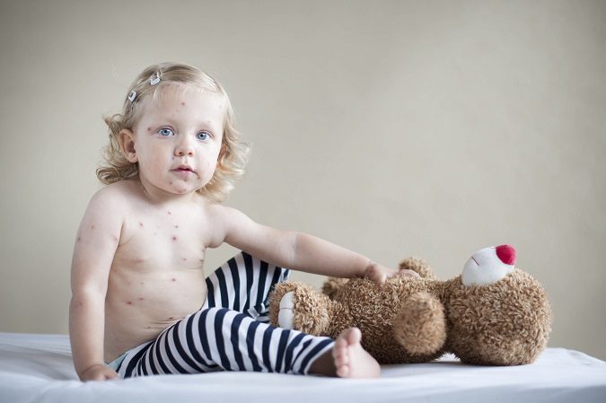 Muchos padres optan por vacunar a sus hijos de la varicela