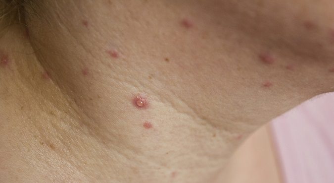 Depende del momento de gestación el riesgo puede ser más o menos alto