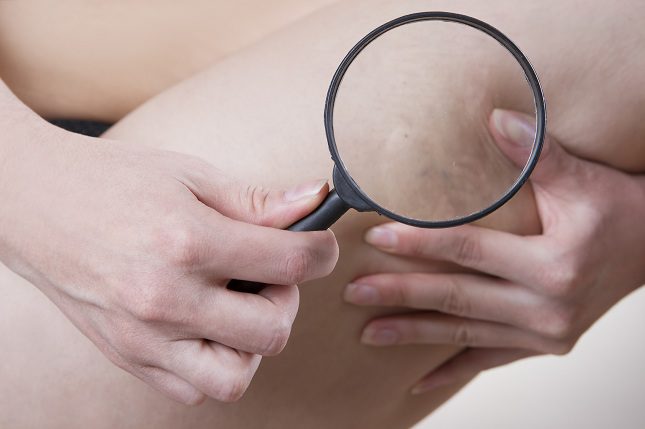 Las varices suelen aparecen con mayor frecuencia durante los meses de verano