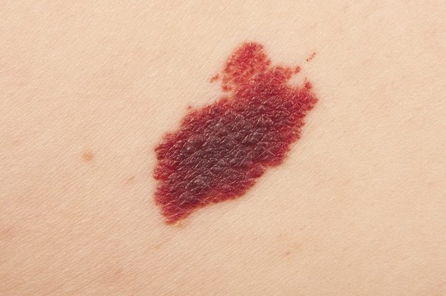 El angioma es un tumor de tipo benigno que se produce a raíz de un crecimiento anormal de los vasos sanguíneos