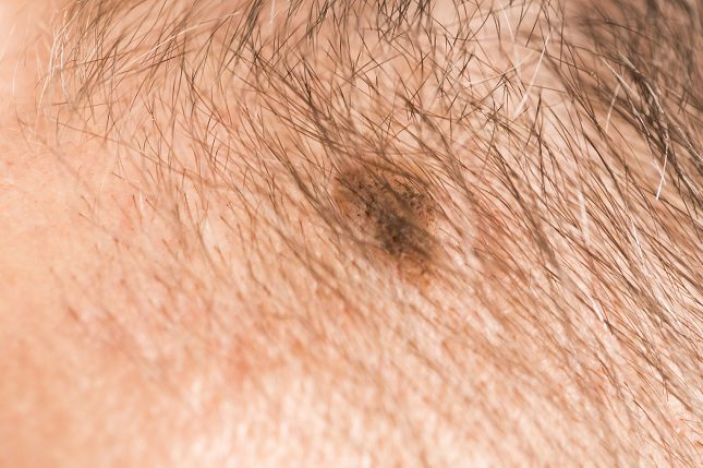 Una tercera forma de tratar un angioma consiste a través del láser