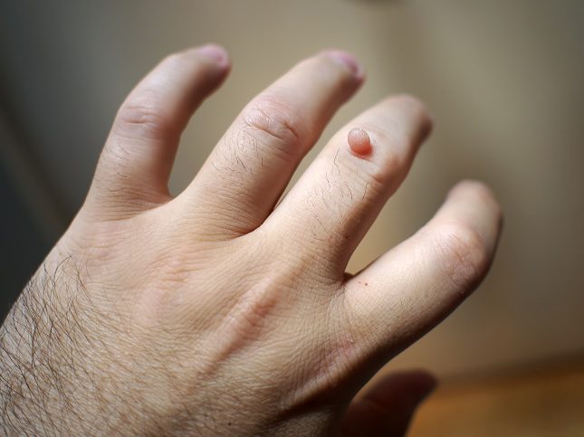 Las verrugas son esas pequeñas manchas bulbosas que aparecen en la piel humana