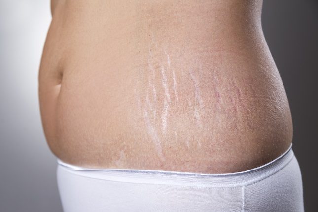 Normalmente, tenemos unas zonas más propensas a sufrir estas antiestéticas marcas