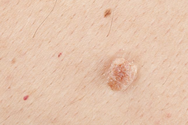Las que aparecen en la zona del cuello pueden ser las más molestas de todas