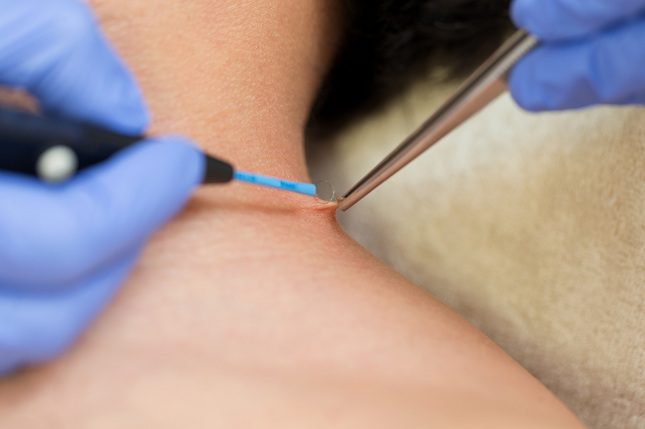 La crioterapia quema el tejido de la zona mediante la congelación de la verruguita