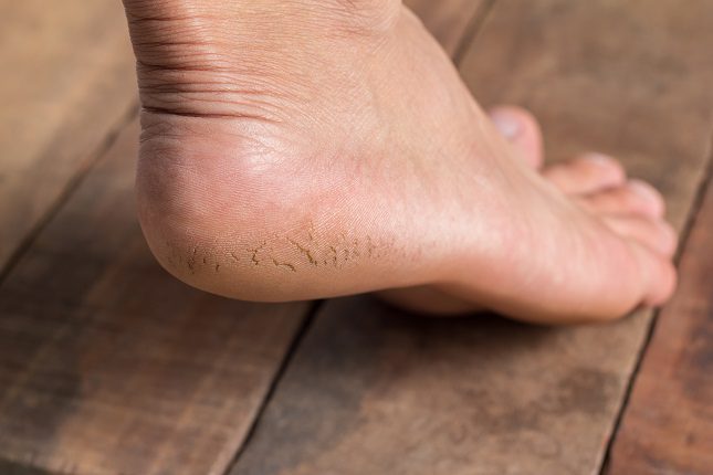  Aparece en personas que someten a una gran carga las plantas de los pies 