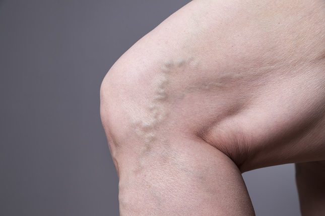 La flebitis es la inflamación de una vena