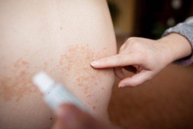 La psoriasis suele aparecer en los codos, rodillas, en el cuero cabelludo, espalda, cara, palma de las manos y plantas de los pies
