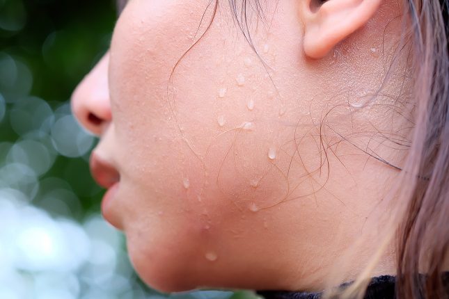 La hiperhidrosis es una benigna caracterizada por un exceso de sudor en una o más zonas del cuerpo