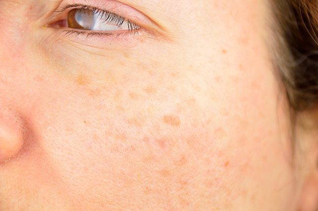 Normalmente las manchas aparecen de forma moteada por el rostro