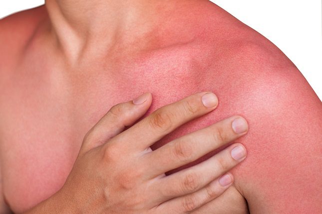 Lo primero que tienes que hacer es hidratarte bebiendo mucha agua para que tu piel se empiece a curar