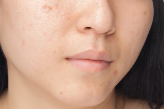 La melanina, es la causa de que aparezcan manchas de cloasma gestacional en la piel