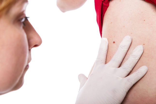 La dermatoscopia digital se utiliza para examinar lunares, entre otras cosas