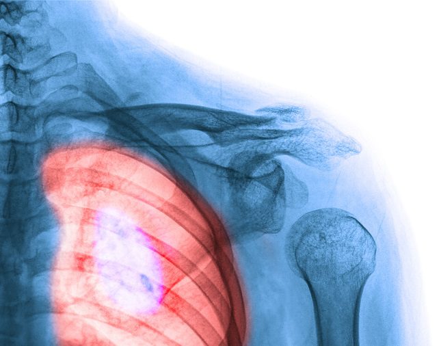 Un alto porcentaje de las personas fumadoras acaban padeciendo cáncer de pulmón