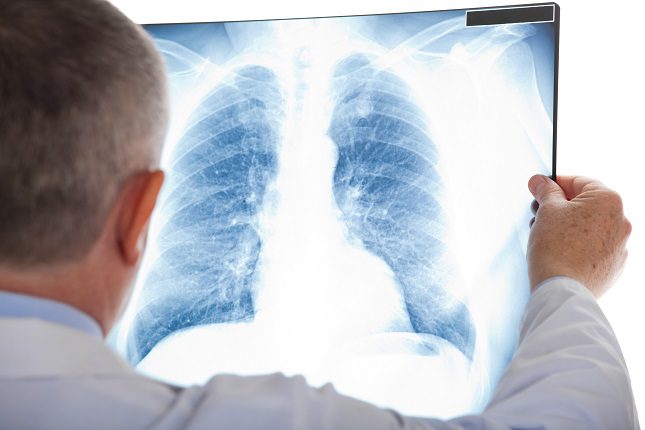 Si no fumas, es casi improbable que el día de mañana tengas este tipo de cáncer