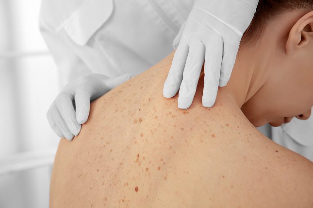 El mejor remedio para que desaparezcan las petequias es la paciencia