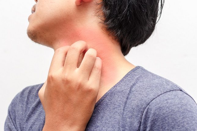 El síntoma más visible de la urticaria es sin lugar a dudas el picor de la piel