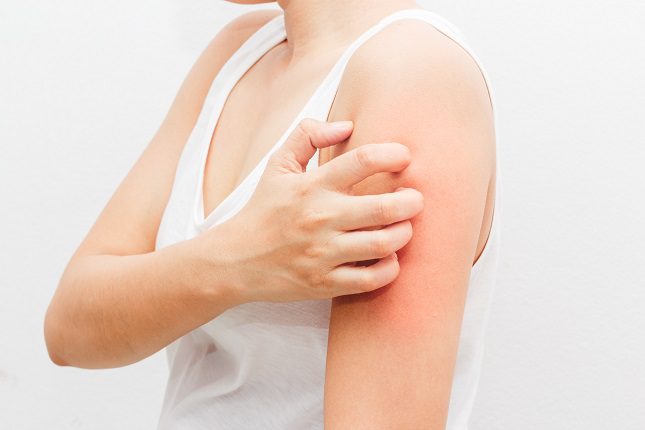  La urticaria es un tipo de afección bastante habitual en la población del siglo XXI
