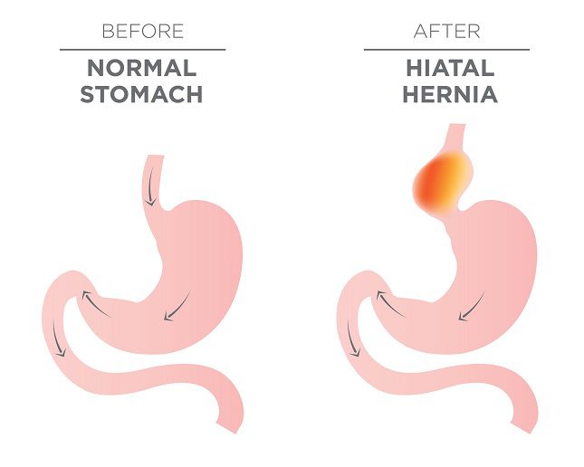 Si la hernia de hiato no entraña mucha gravedad basta con seguir una serie de hábitos que ayuden a la persona a mejorar