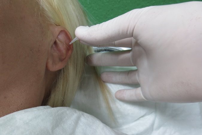 La acupuntura como una buena herramienta de tratamiento