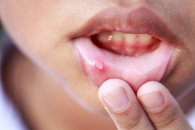  La estomatitis es temporal y suele durar como mucho unos 10 días